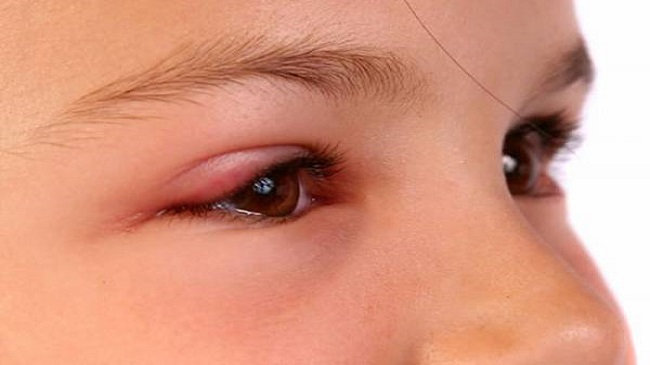 عوامل مبتلا به عفونت چشم و راه های درمان عفونت چشم