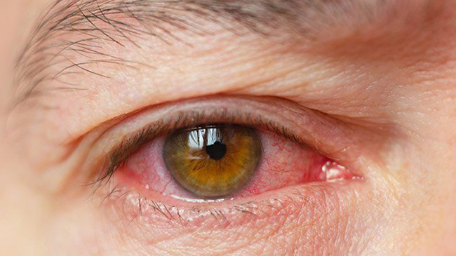 فشار چشم چیست و باعث چه بیماری می شود؟