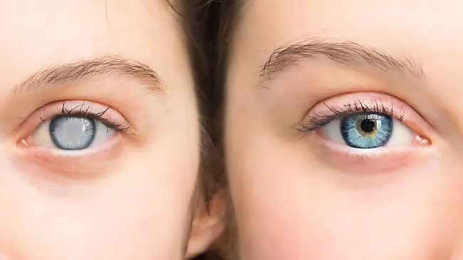 آب‌مروارید (کاتاراکت): علائم، عوامل خطر و روش‌های نوین درمان