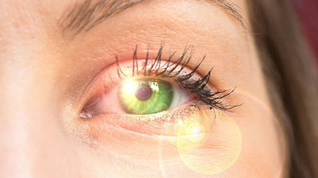 آفتاب سوختگی چشم یا فوتوکراتیت چیست؟