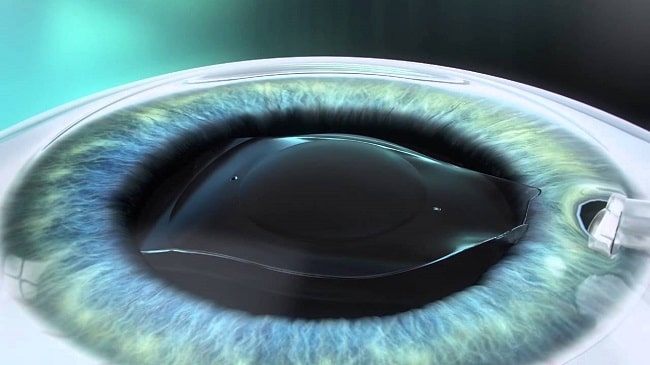خطرات کاشت لنز تماسی در چشم
