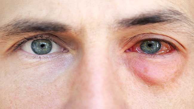 علائم اولیه بیماری‌های چشمی شایع و روش تشخیص به موقع