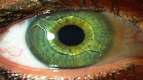 لنزهای داخل چشمی(لنزهای ایمپلنت)