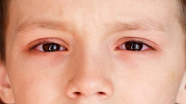 معرفی بیماری چشم صورتی (ورم ملتحمه) و راه های درمان آن