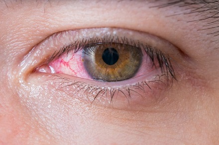 آلرژی چشم-دیالنز