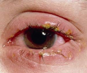 عفونت چشم - خرید لنز طبی
