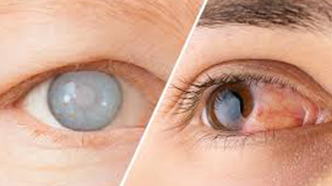 آب‌مروارید (کاتاراکت): علائم، عوامل خطر و روش‌های نوین درمان