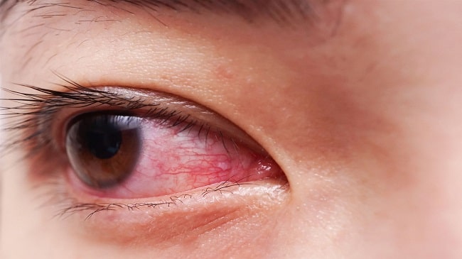از علائم تا درمان قرمزی چشم