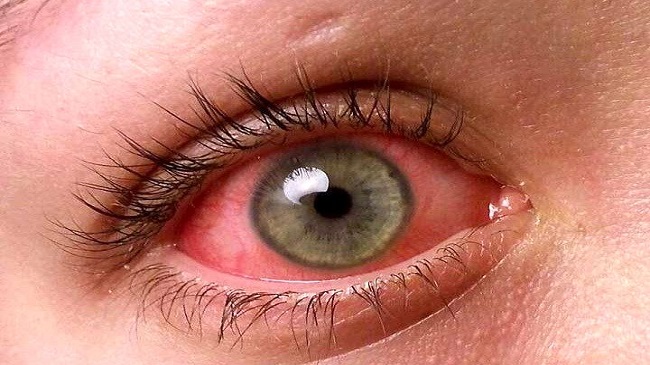 سوختگی شیمیایی چشم چیست؟