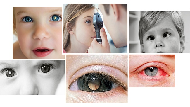 شایع‌ترین تومور داخل چشمی کودکان را بشناسیم