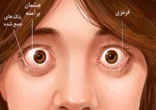 نقش-بیماری-تیروئید-در-بروز-اختلال-بینایی