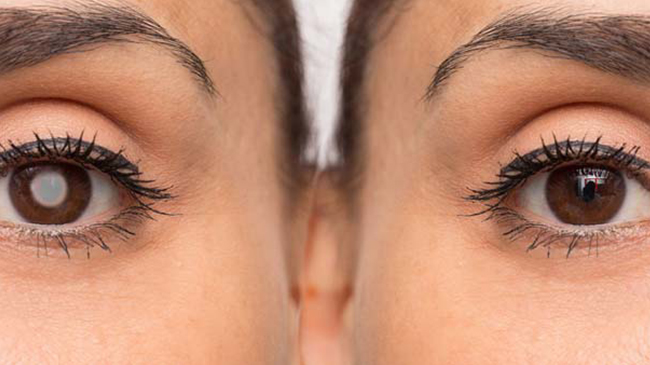 گلوکوم (آب سیاه): اهمیت تشخیص زودهنگام و فناوری‌های نوین پایش فشار چشم